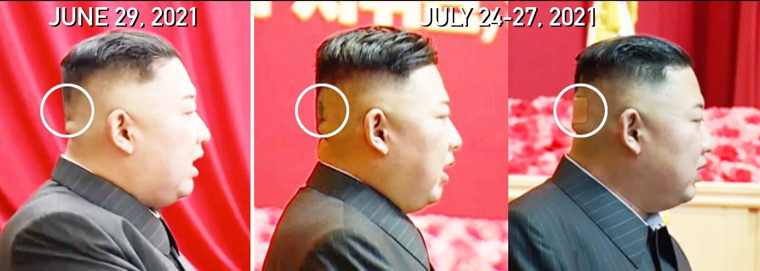 Пятна на голове Ким Чен Ына: в сети обсуждают здоровье северокорейского диктатора