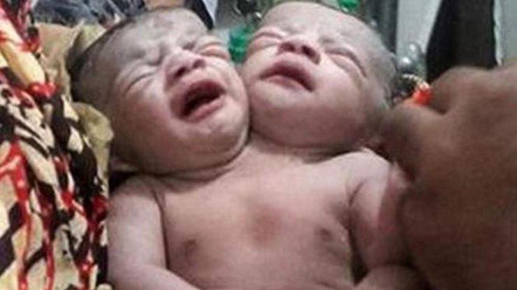 В Бангладеш родился двухголовый ребенок