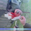 В Одессе хирурги вытащили курсанту гранату из руки
