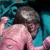 В Индии родился ребенок с синдромом русалочки 