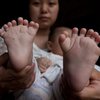 В Китае родился ребенок с 31 пальцем и 4 ладошками (фото)