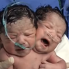 В Мексике родился мальчик с двумя головами (видео) 