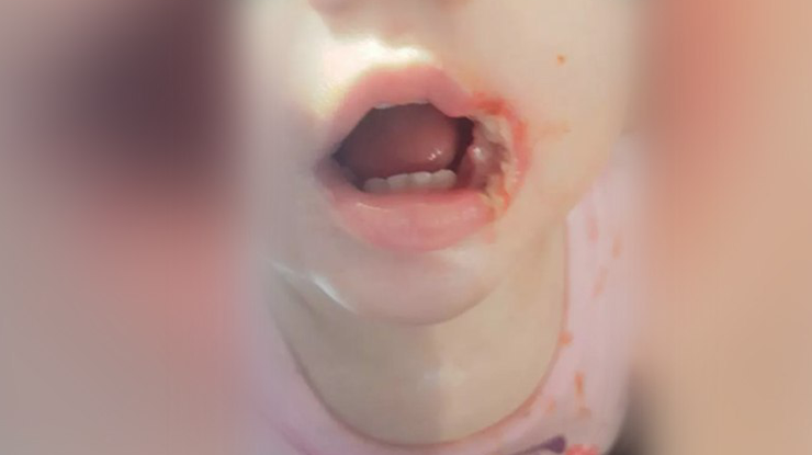 Ребенок потянул провод, подключенный к сети, в рот и в считанные секунды получил тяжелые ожоги слизистой и губ