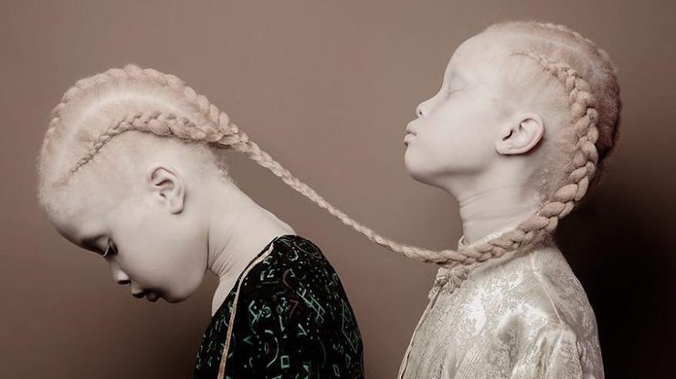 11-летние близнецы-альбиносы 