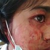 В Таиланде девочка "потеет кровью" из-за редкого заболевания (видео)