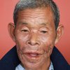 Мужчина 30 лет прожил с огромной опухолью во рту (фото) 