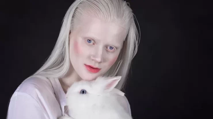 Люди с альбинизмом сталкиваются с многочисленными формами дискриминации