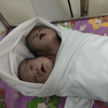 В Мьянме родился двухголовый младенец