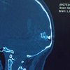 "Уламок застряг у мозку": лікарі дивом врятували постраждалу в Умані
