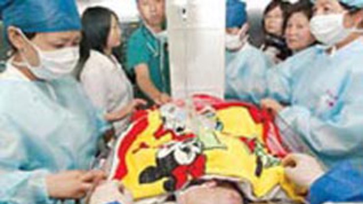 В Китае выписана из больницы одна из разделенных в июле сиамских сестер-близнецов