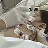 Чилийские хирурги разделили сиамских близнецов