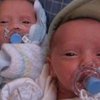 В Британии родились "феноменальные" близнецы