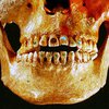 Древние люди украшали зубы драгоценными камнями