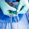 Французский хирург случайно вырезал пациентке здоровую почку