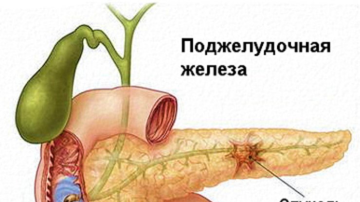Сладкая газировка провоцирует рак поджелудочной железы