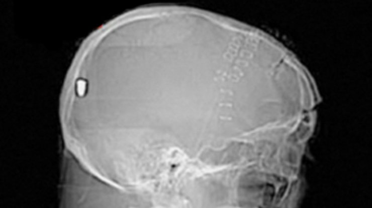 В Британии у пациента с инсультом нашли пулю в голове
