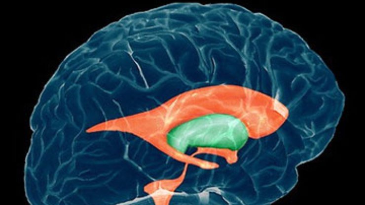 О риске развития шизофрении свидетельствует строение мозга новорождённых