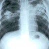 ВОЗ: В Европе туберкулез все чаще не поддается лечению