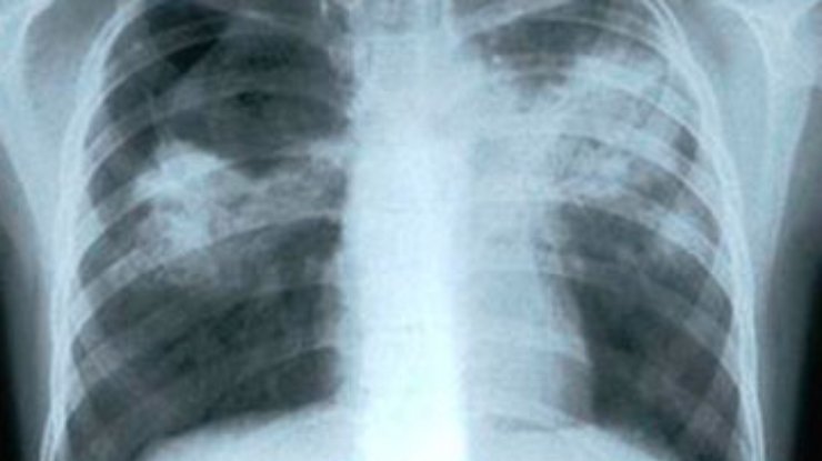 ВОЗ: В Европе туберкулез все чаще не поддается лечению