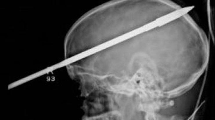 В США медики извлекли гарпун из черепа подростка