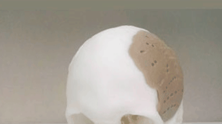 В США пациенту пересадили распечатанный на 3D-принтере череп
