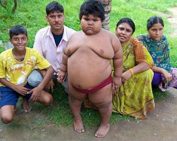 В Индии 5-летняя девочка весит 76 килограммов