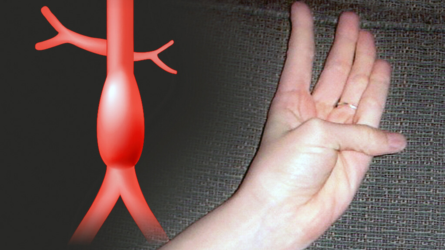 Аневризма аорты: как распознать болезнь по руке и пальцу