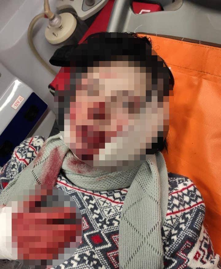 В Киеве мужчина изувечил ножом лицо своей сожительнице
