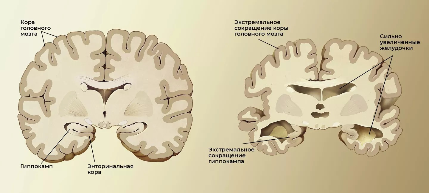 Мозок здорової літньої людини (ліворуч) та пацієнта з хворобою Альцгеймера (праворуч)