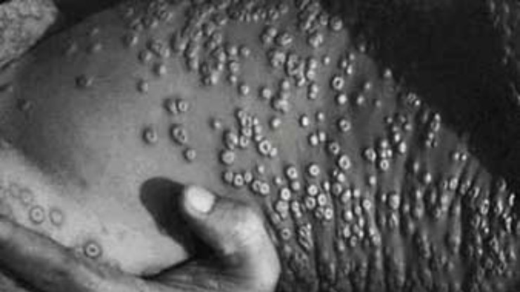 Американцы боятся оспы и покупают от нее вакцину