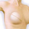 Женщине ампутировали грудь после введения силикона
