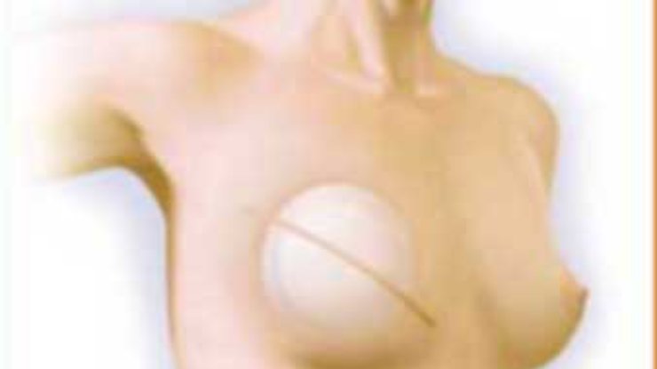 Женщине ампутировали грудь после введения силикона