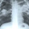 Уровень заболеваемости туберкулезом в Киеве в 2 раза ниже среднеукраинского