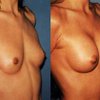 Женщины с силиконовой грудью совершают суицид чаще