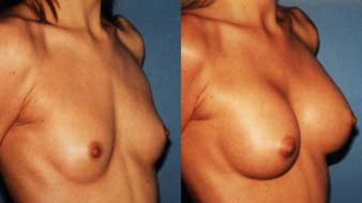 Женщины с силиконовой грудью совершают суицид чаще