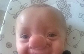 В Великобритании родился мальчик с большим носом. Фото The Daily Mail