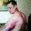 Пастор о пытках в Донецке: Меня били 5 человек - палками, ногами, кулаками (фото)
