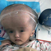 В Китае ребенку пересадили напечатанный на 3D-принтере череп (фото)