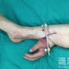 В Китае хирурги пришили руку пациента к его ноге (фото)