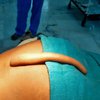 В Индии парню удалили 18-сантиметровый хвост (видео)