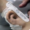 В Китае врачи вырастили ухо на руке у пациента (фото) 
