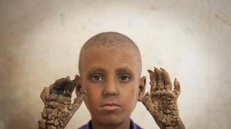 В Бангладеше мальчик превращается в дерево