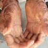 В Индии девочка-змея сбрасывает кожу каждые полтора месяца (фото) 
