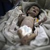 Лицо войны: фото истощенного младенца шокировали сеть 