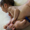 Жуткая аномалия: ребенок родился с приросшим братом-паразитом (фото) 