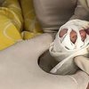 Младенцу грозит ампутация пальца из-за маминого волоса (фото)