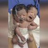 В Мексике родился двухголовый ребенок (видео)