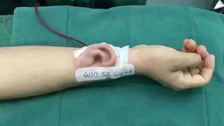 Китайцу пересадили выращенное на его руке ухо