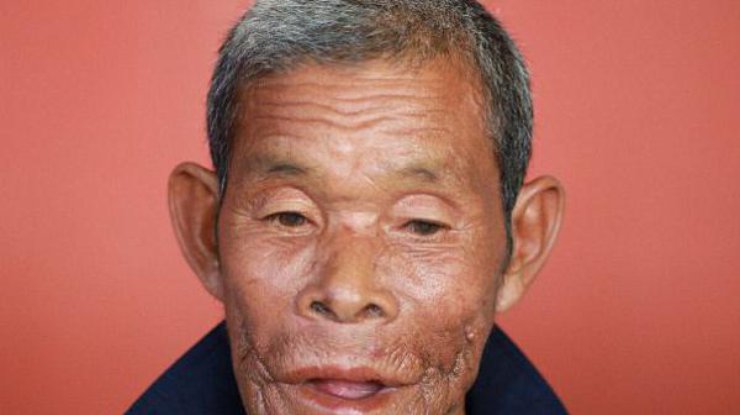 Мужчина после операции / Фото: Eng Kheng