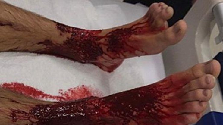 Ноги истекали кровью от мельчайших укусов. Фото Foxnews